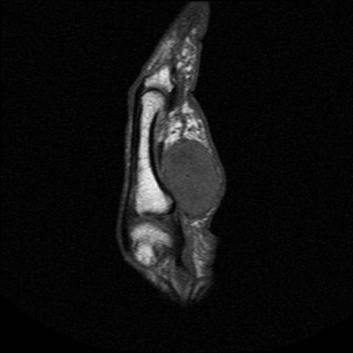 Sarcoma Hand0001